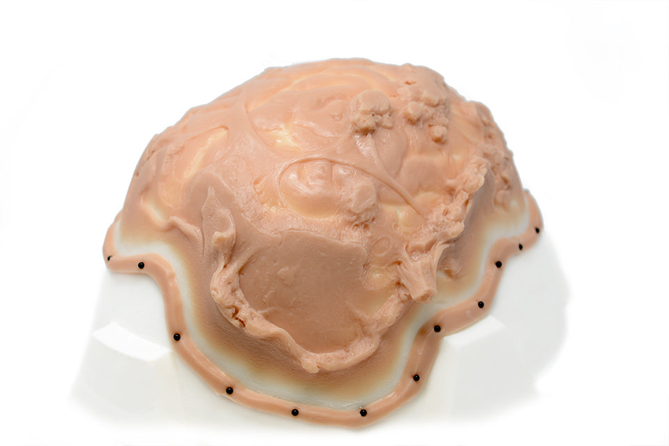 Exposed Brain Trauma