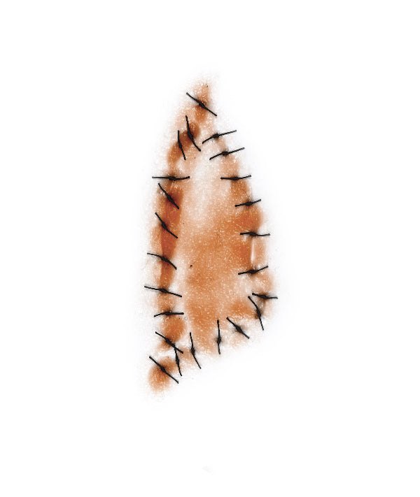 Triangular Shaped Sutured Wound