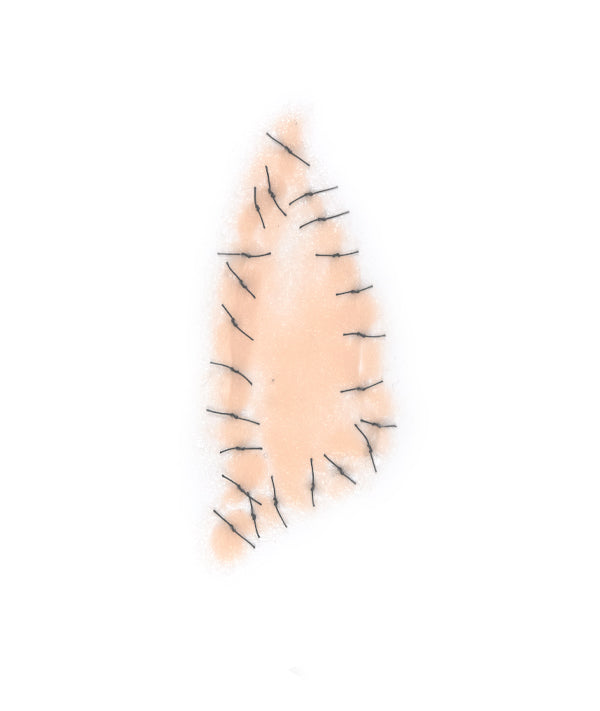 Triangular Shaped Sutured Wound
