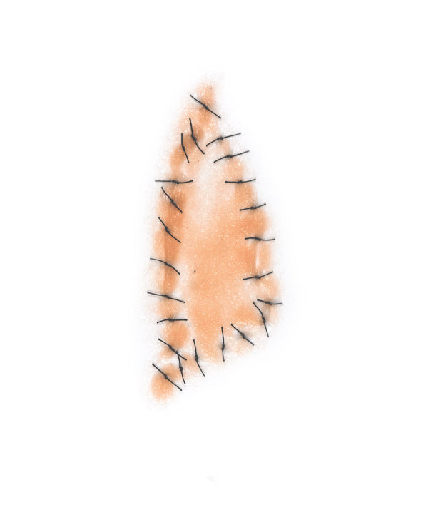 Triangular Shaped Sutured Wound