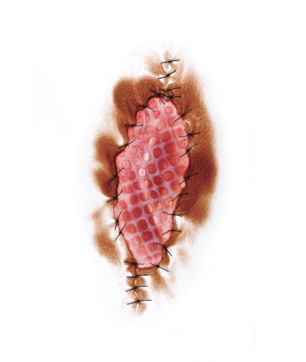 Skin Graft 1