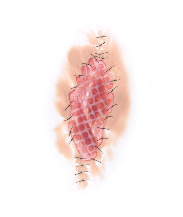Skin Graft 1