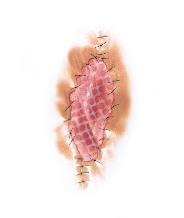 Skin Graft 1