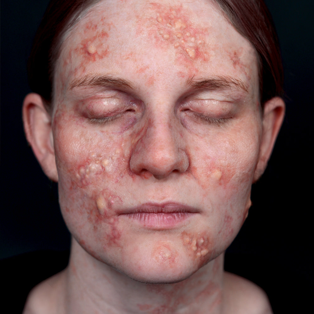 Allergic Reaction Kit