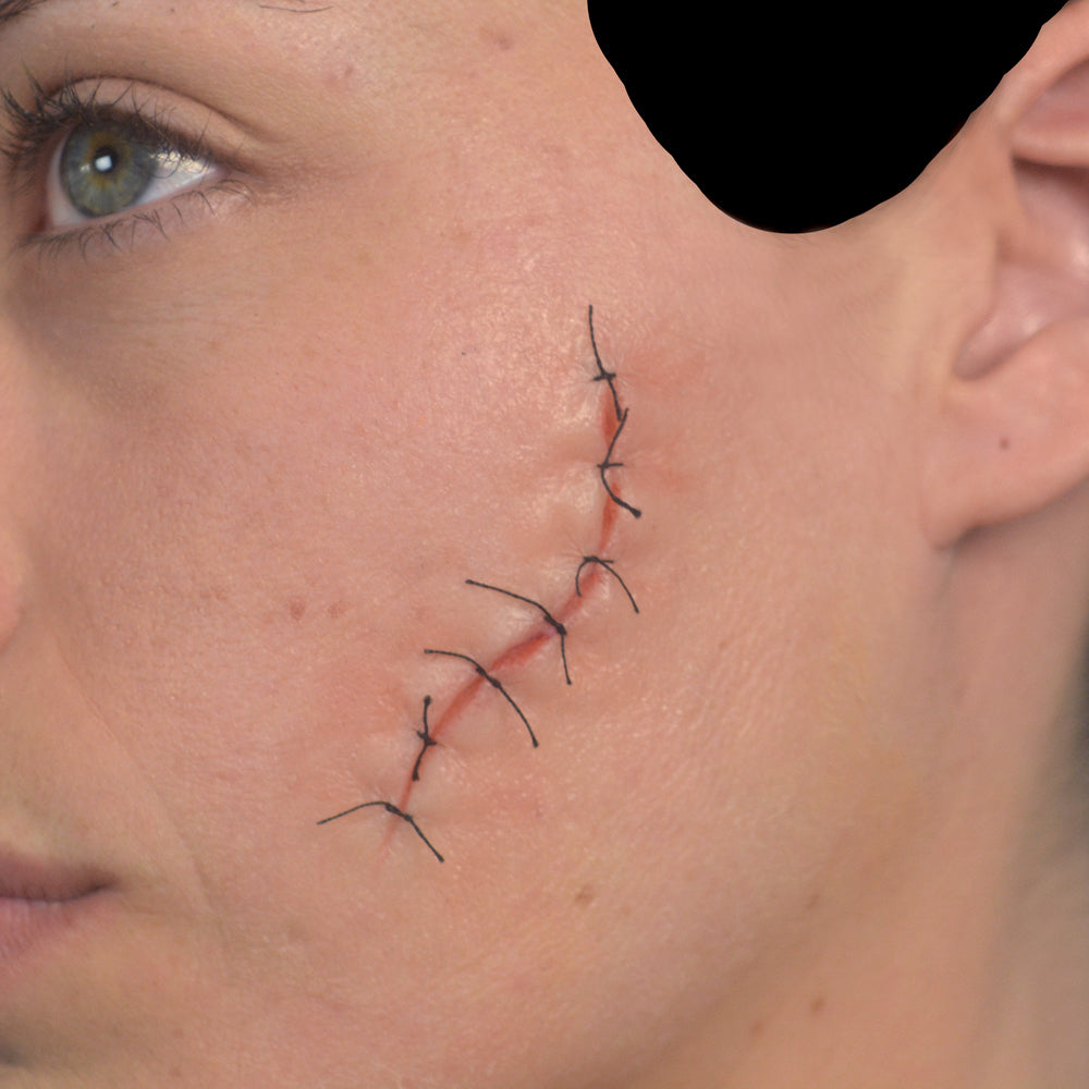 Facial Suture Wound