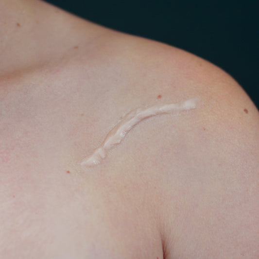 Curved Keloid Scar 5