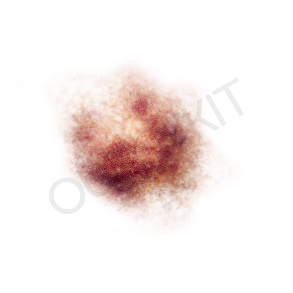 Bruise 2