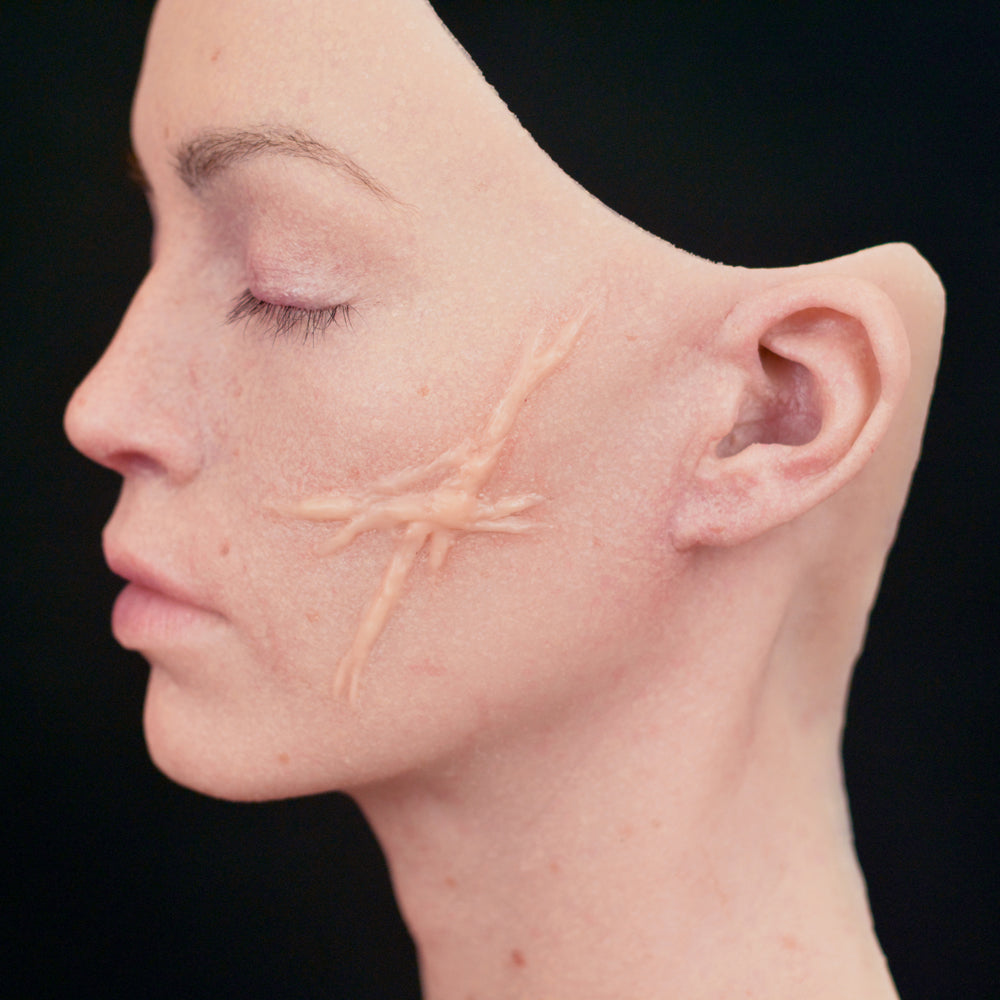 Dynamic Keloid Scar 3
