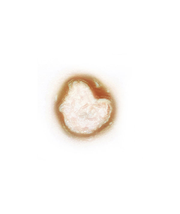 Acid Burn 1