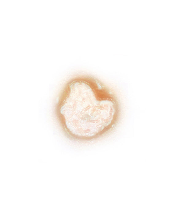 Acid Burn 1