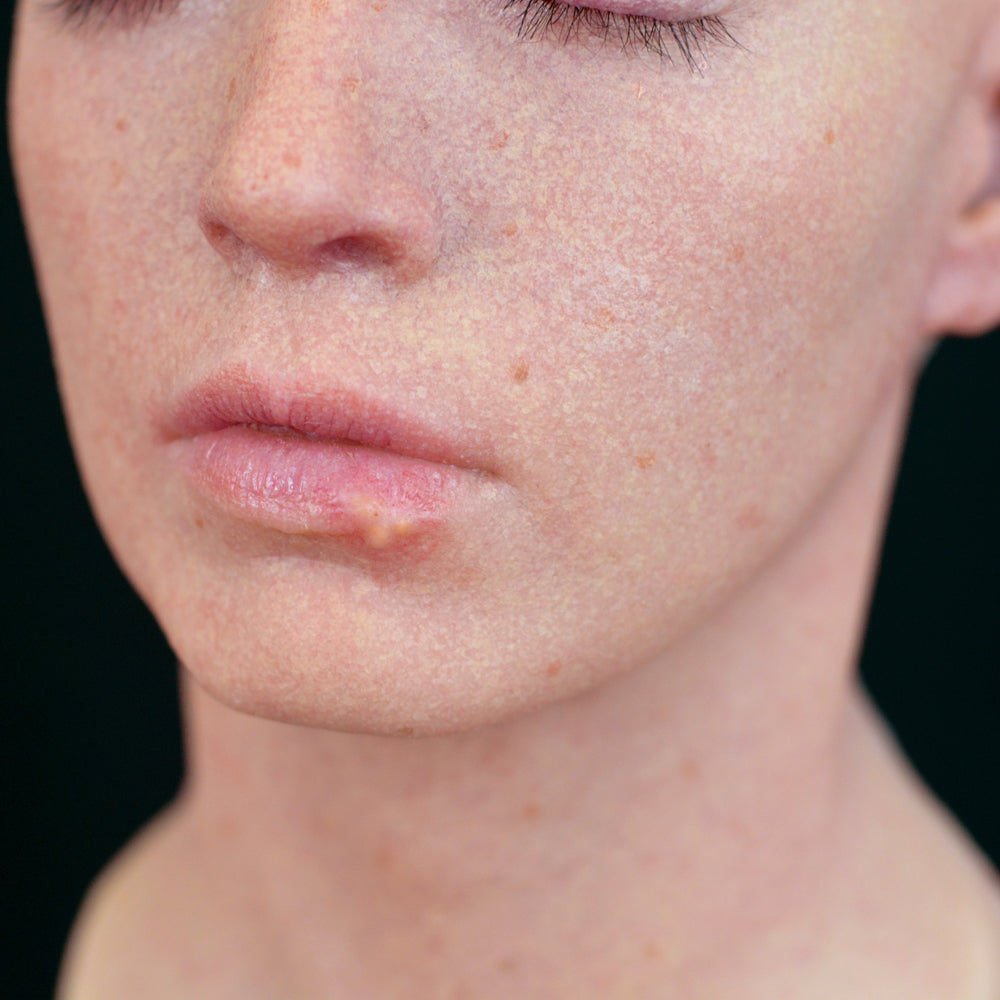 Cold Sore 2
