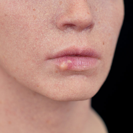 Cold Sore 3
