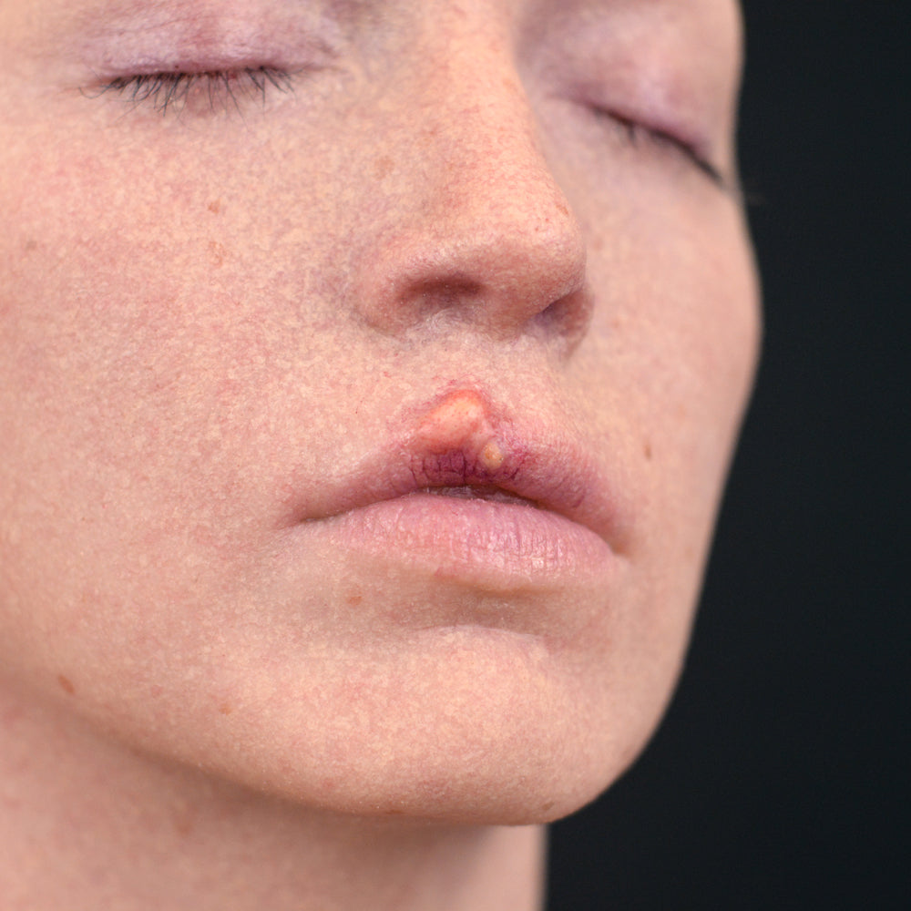 Cold Sore 4