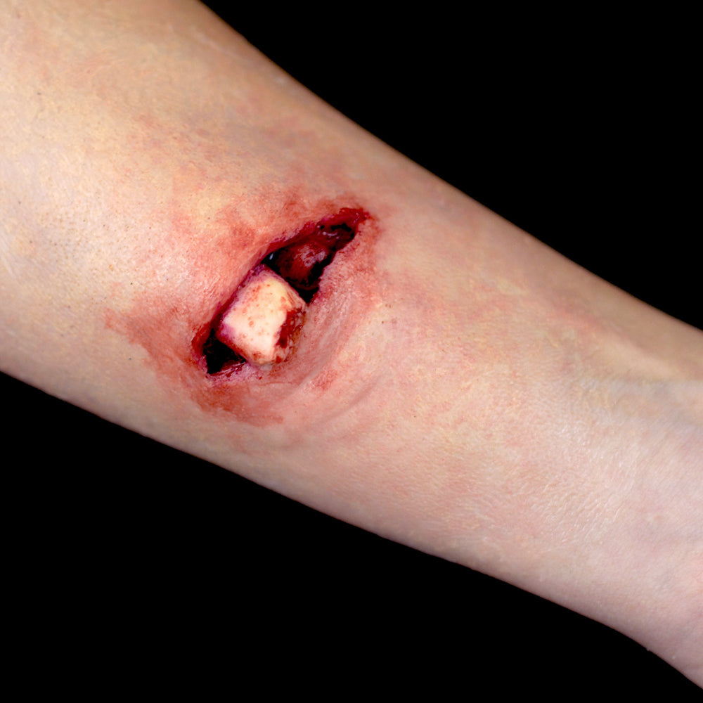 Compound Fracture 1