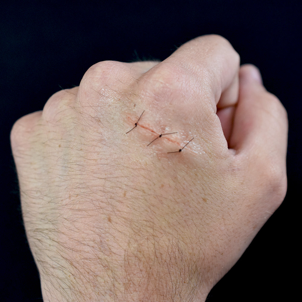 Sutured Wound 3 Stitch