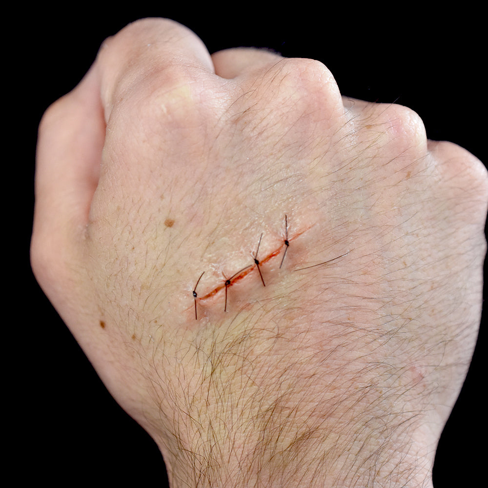 Sutured Wound 4 Stitch