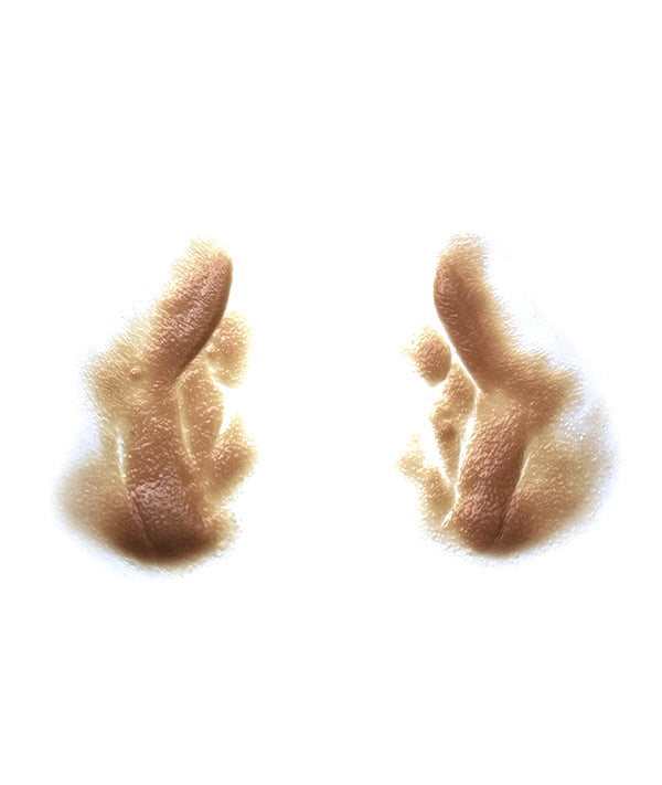 Male Nasolabial Folds and Jowls 3