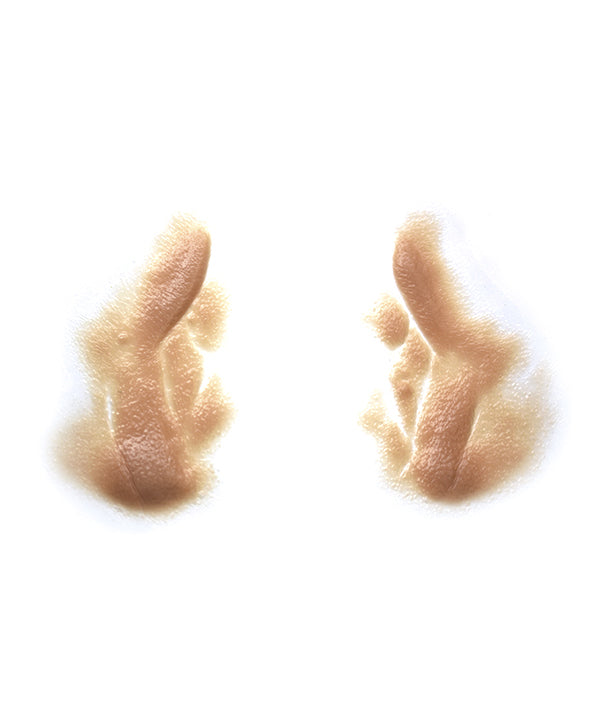 Male Nasolabial Folds and Jowls 3