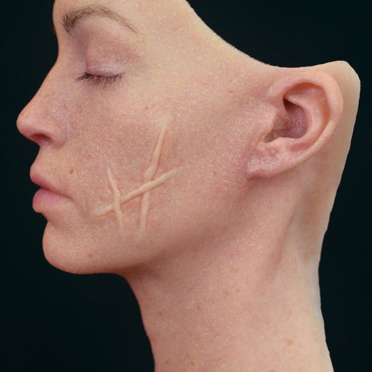 H Shaped Scar