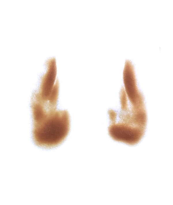 Female Nasolabial Folds with Jowls 1