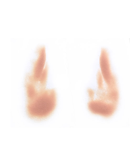 Female Nasolabial Folds with Jowls 1