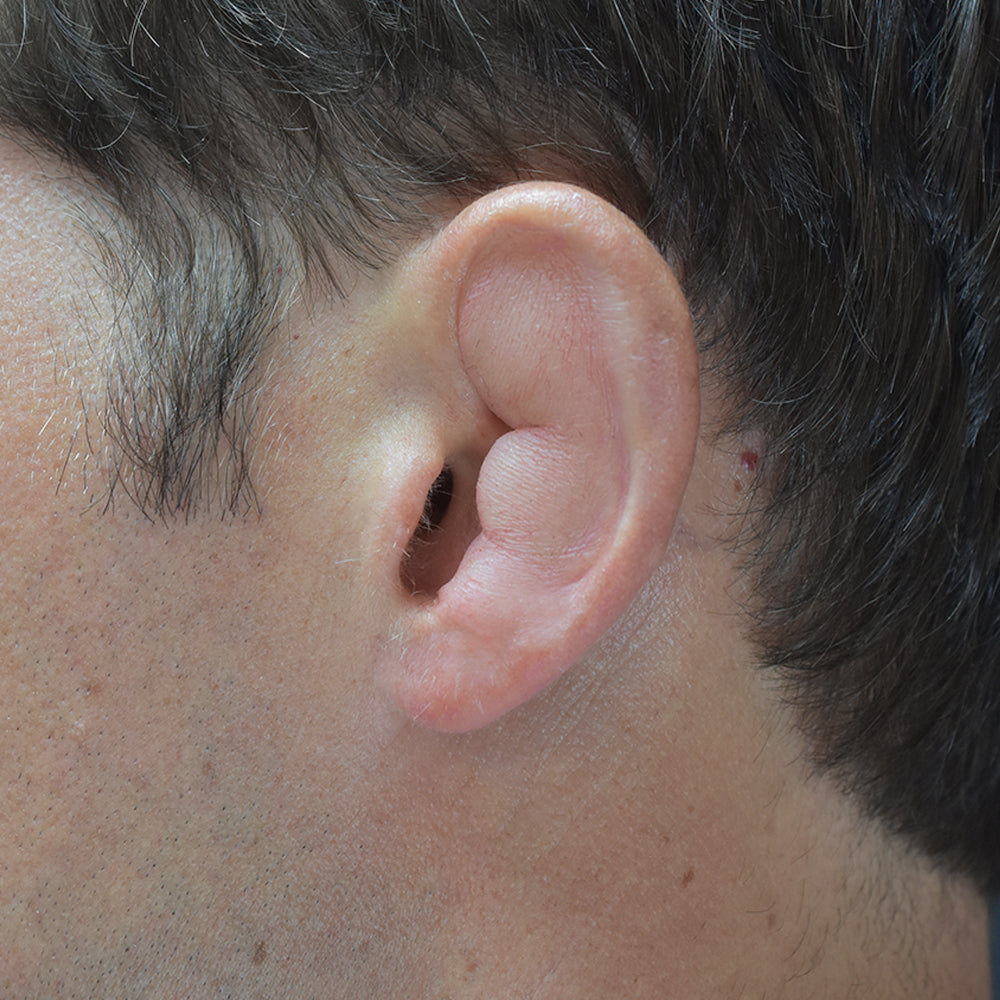 Cauliflower Ear Left 1