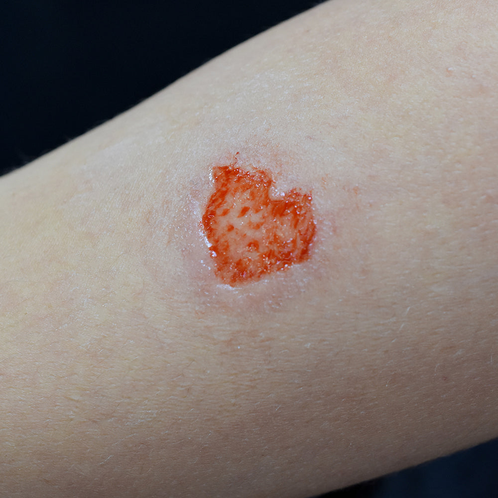 2nd Degree Burn 1