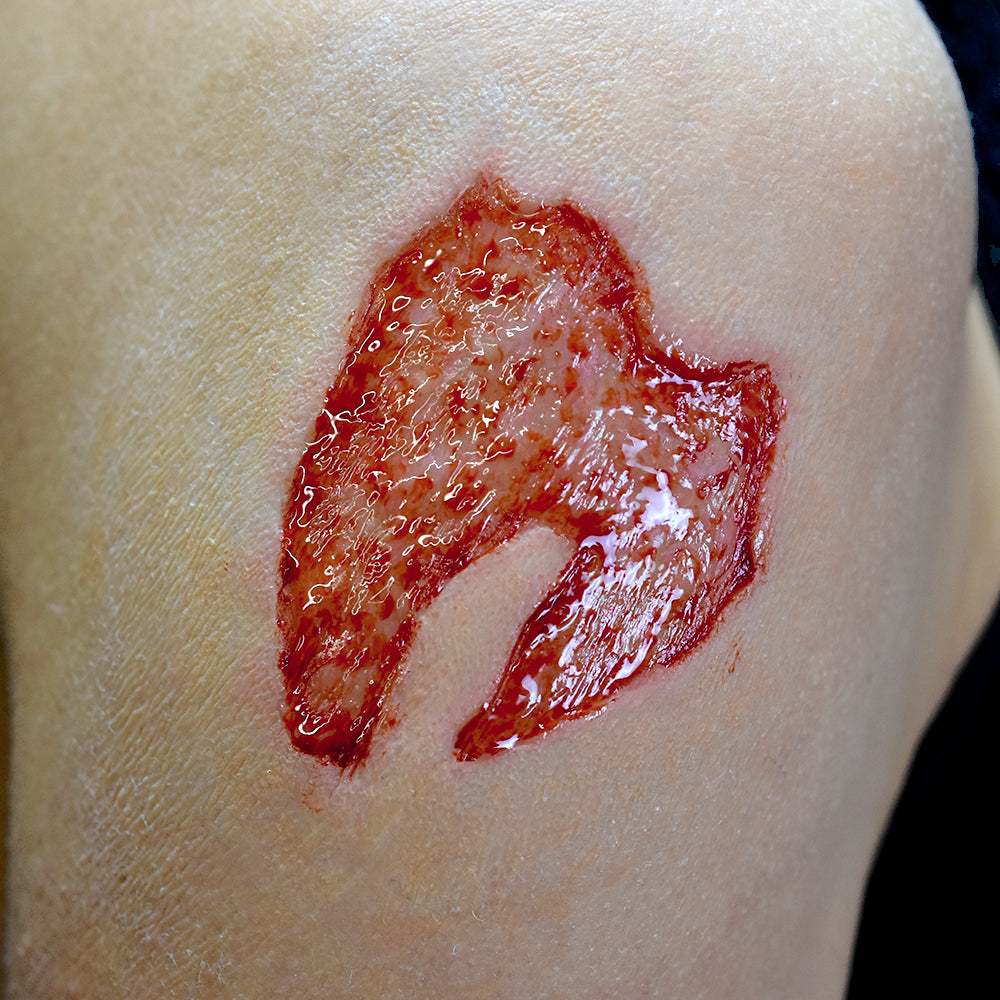 2nd Degree Burn 4