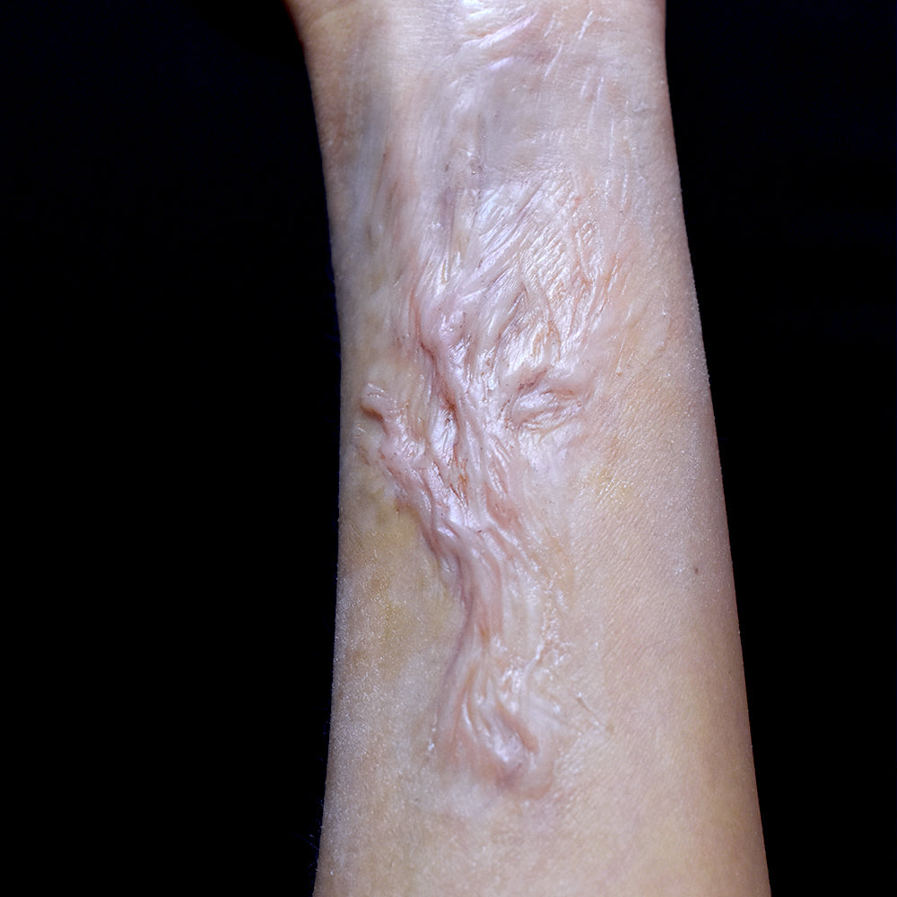 Healed Burn Scar 4