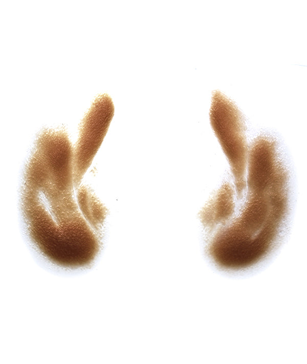 Male Nasolabial Folds and Jowls 4