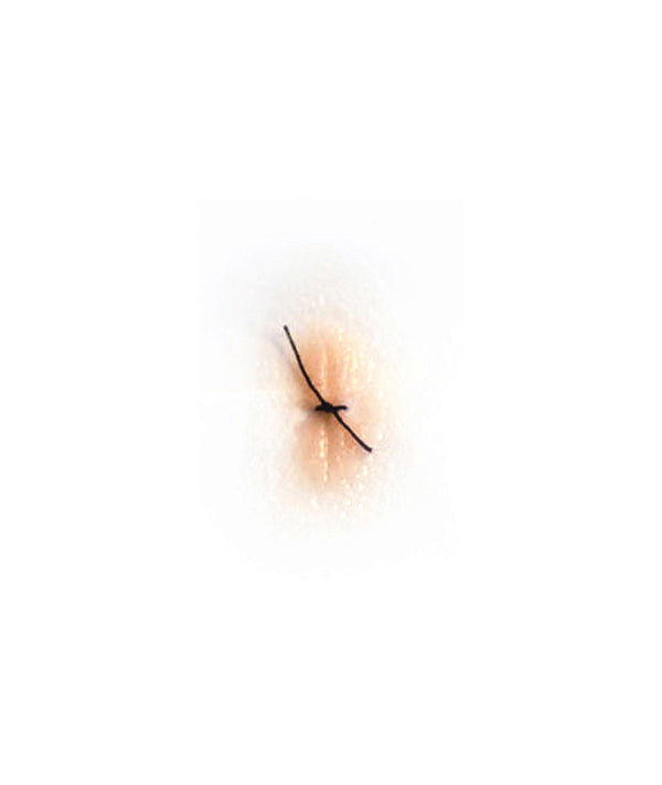 Sutured Wound (Small)