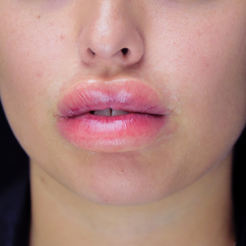 Swollen Lips