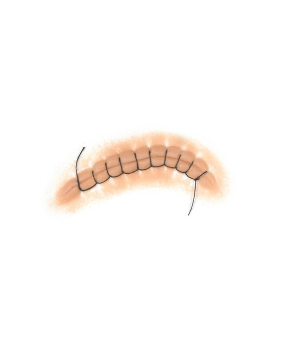 Locking Stitch Suture 1