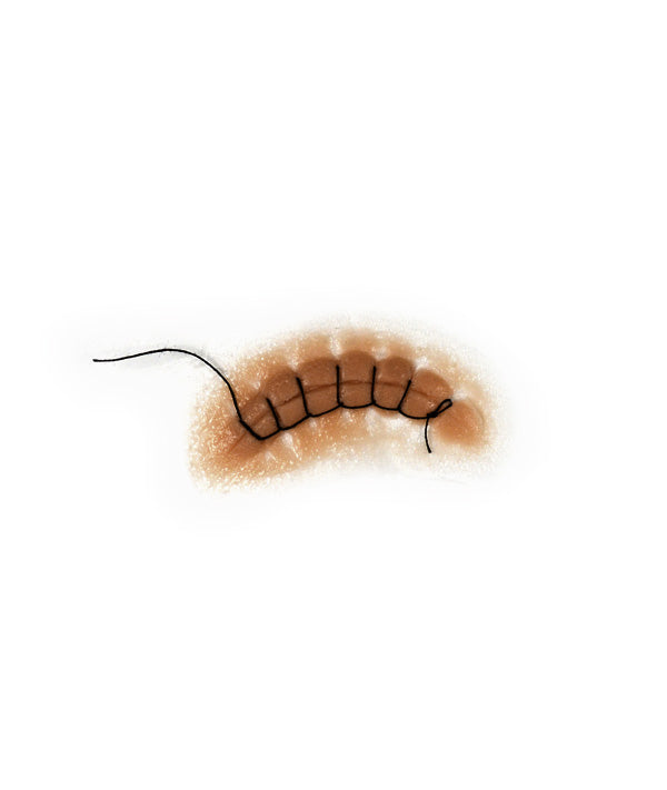 Locking Stitch Suture 2