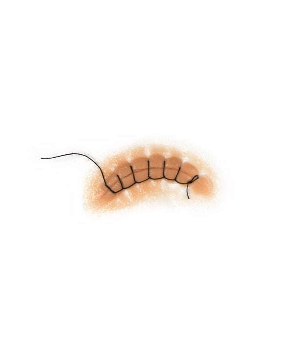 Locking Stitch Suture 2