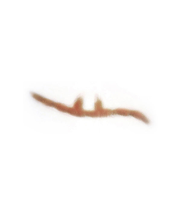Split Keloid Scar