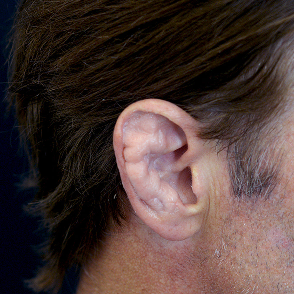 Cauliflower Ear Right 2