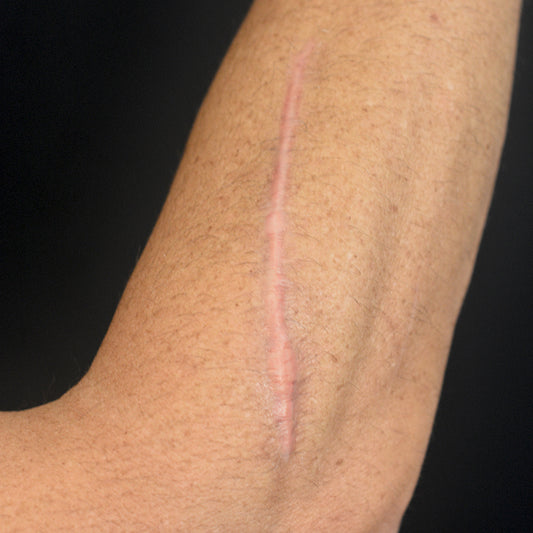 Serrated Knife Scar 4