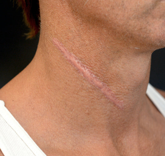 Serrated Knife Scar 5