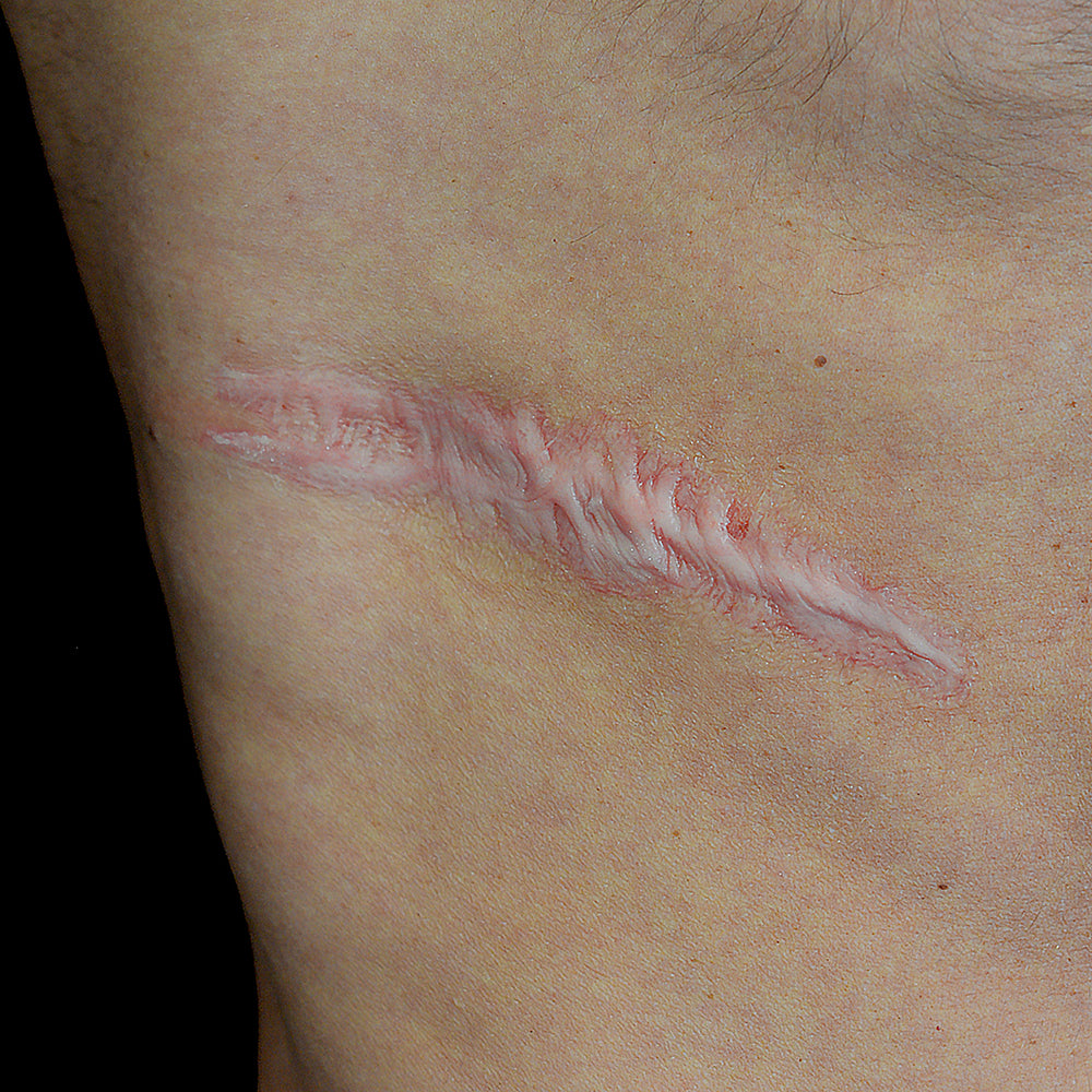 Back Scar