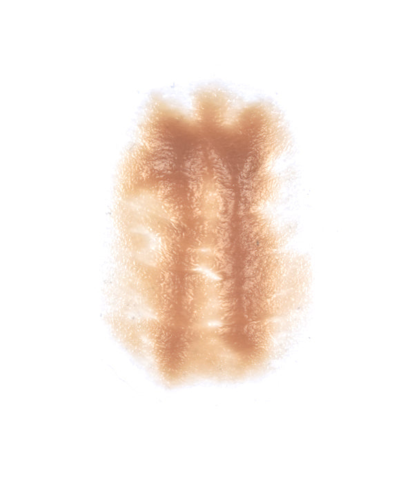 Female Neck Waddle 7