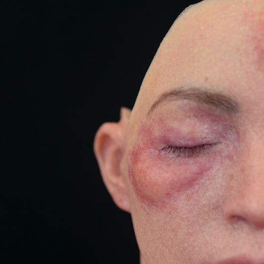 Swollen Right Eye (Medium)
