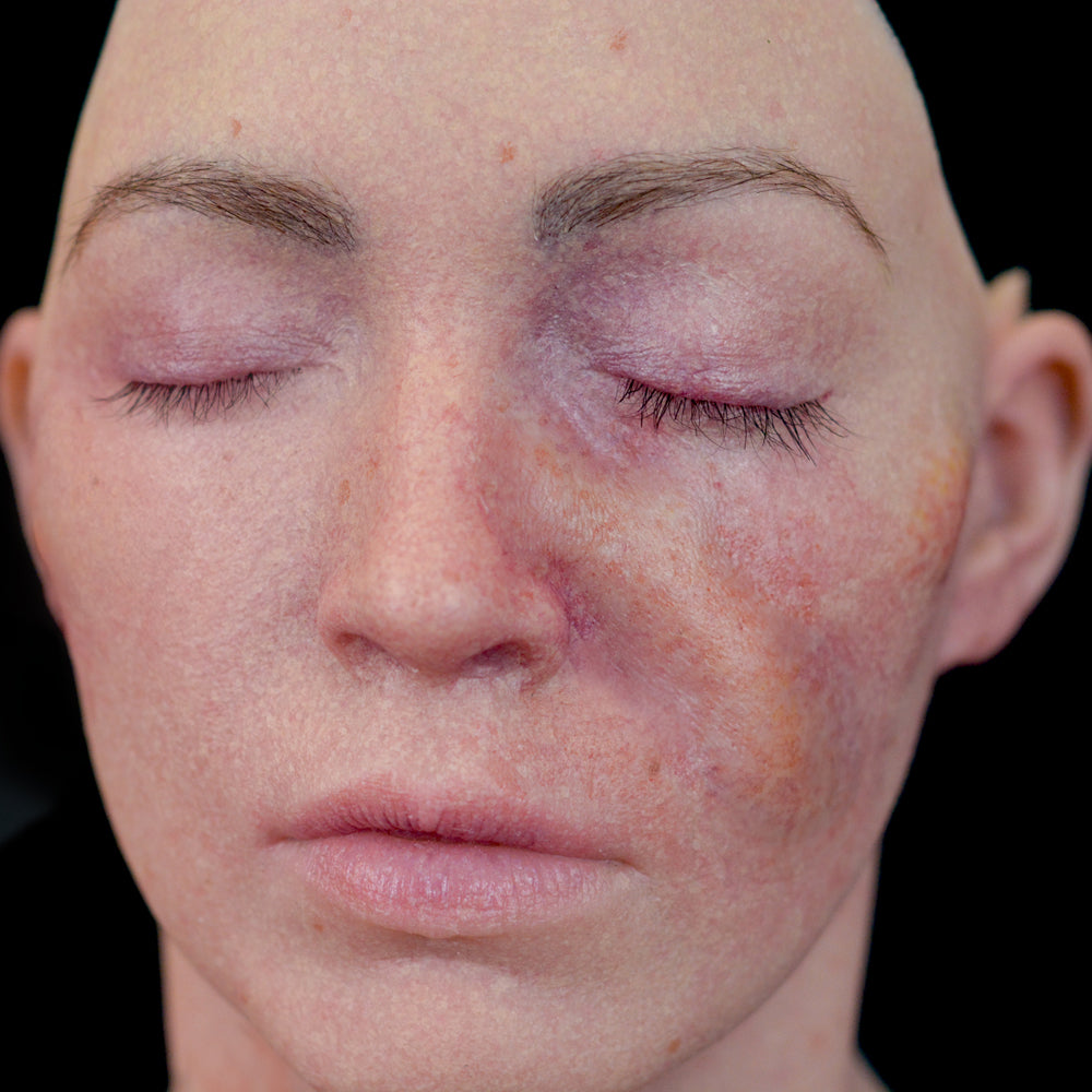 Swollen Right Nasolabial fold