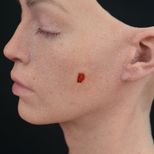 Puncture Wound (Medium)