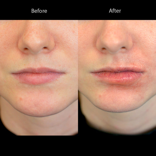 Subtle Swollen Lips