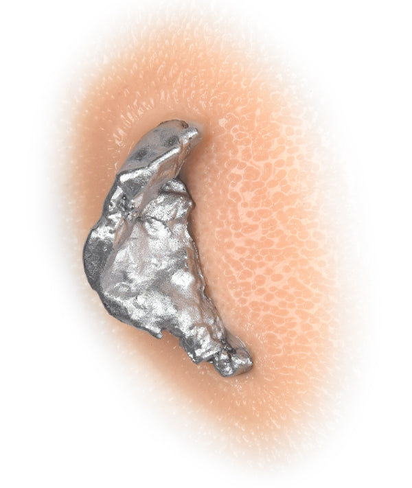 Shrapnel Injuries Bone Metal Shrapnel Wound 6 – Out of Kit