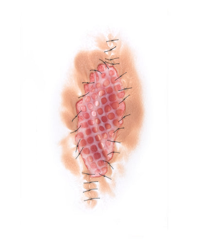 Skin Graft 1