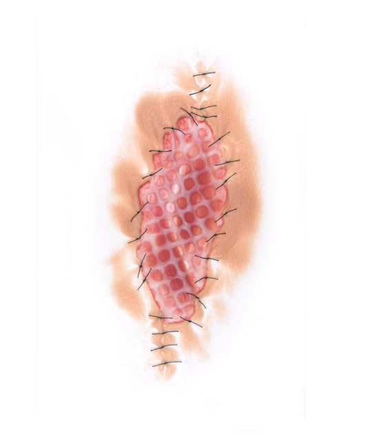 Skin Graft 1