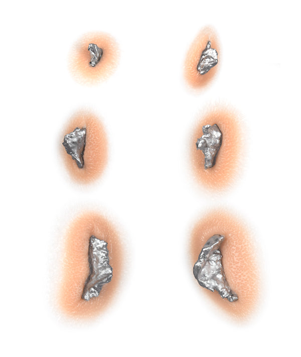 Schrapnel Injuries Metal Shrapnel Wound Kit – Out of Kit