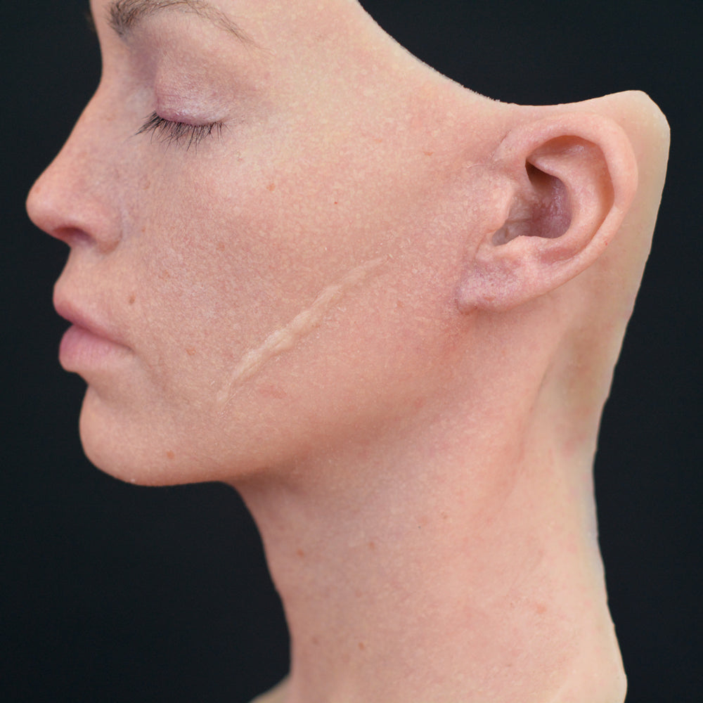 Facial Suture Wound Scar